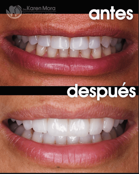 Carillas dentales — antes y después de un caso real