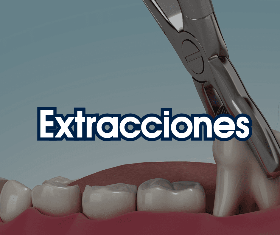 Extracciones