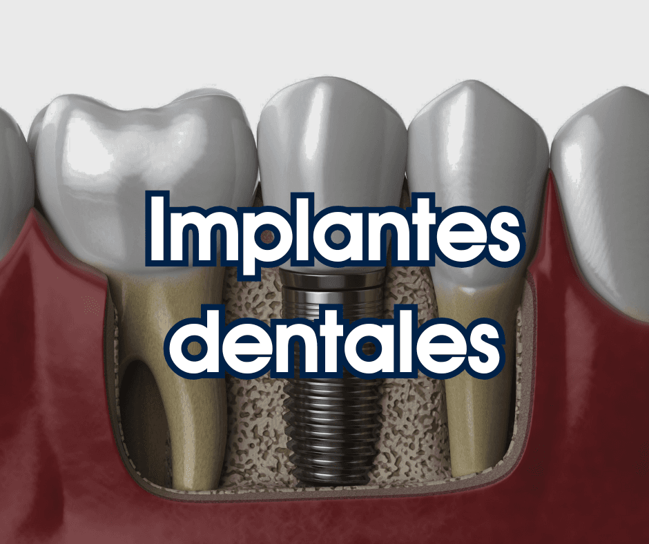 Implantes