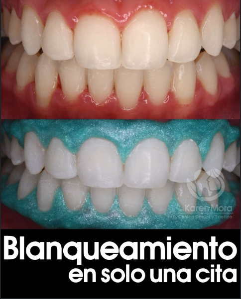 Blanqueamiento dental — antes y después en una sola sesión